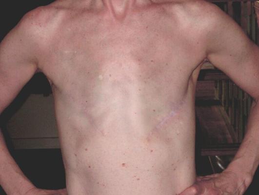 Mastectomy