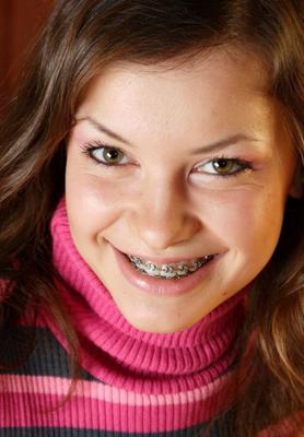 Chicas con brackets