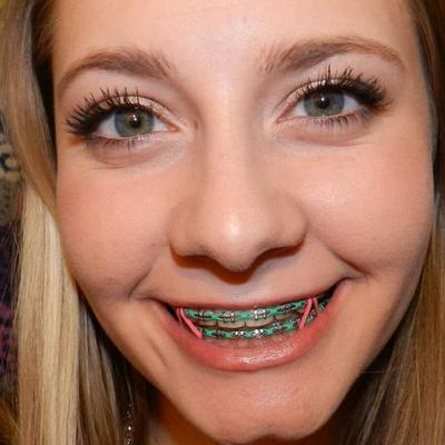 Braces Images