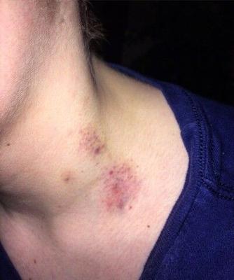 Hickeys