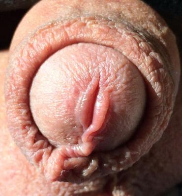 Foreskin I