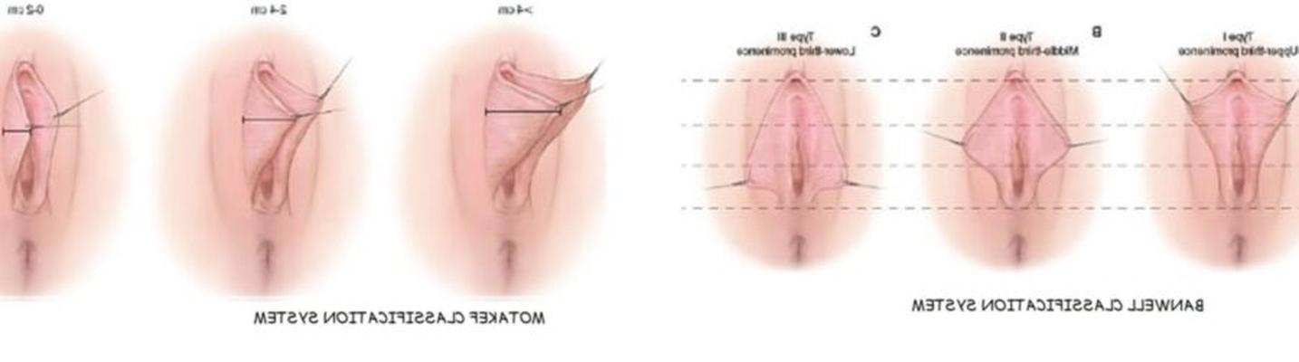 Type I Labia