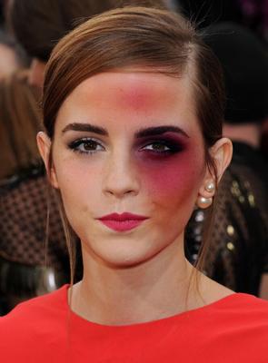 Falsificaciones de moretones de Emma Watson por KK