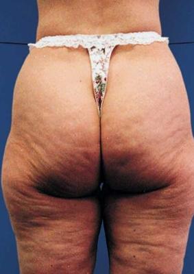 Ich liiiebe Cellulite